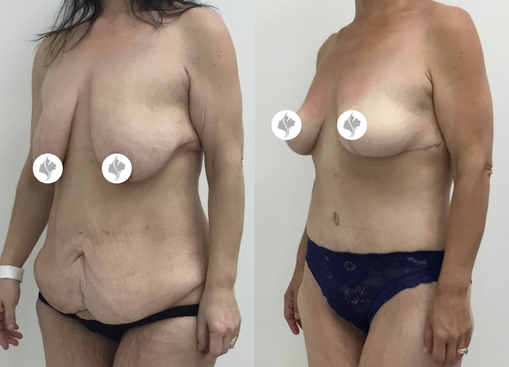 This is one of our beautiful post-bariatric body contouring patient #34