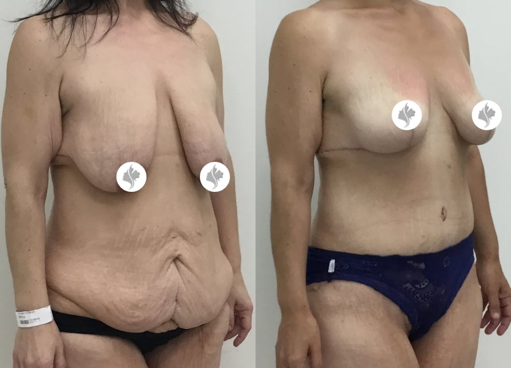 This is one of our beautiful post-bariatric body contouring patient #34