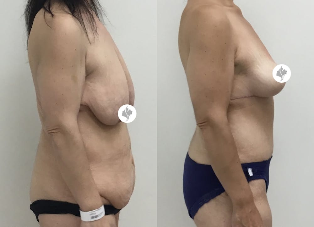This is one of our beautiful post-bariatric body contouring patient #34