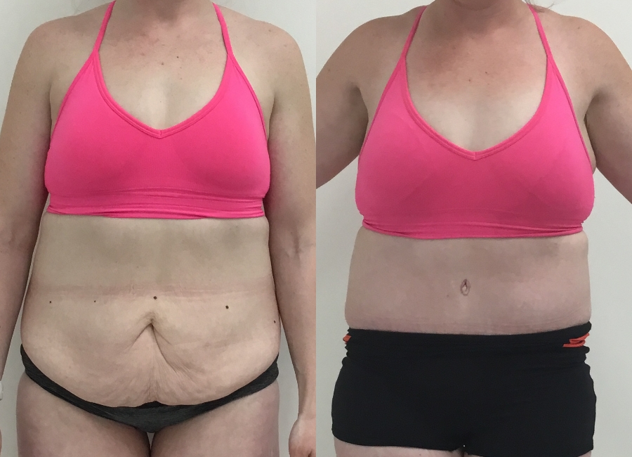This is one of our beautiful tummy tuck patient 63