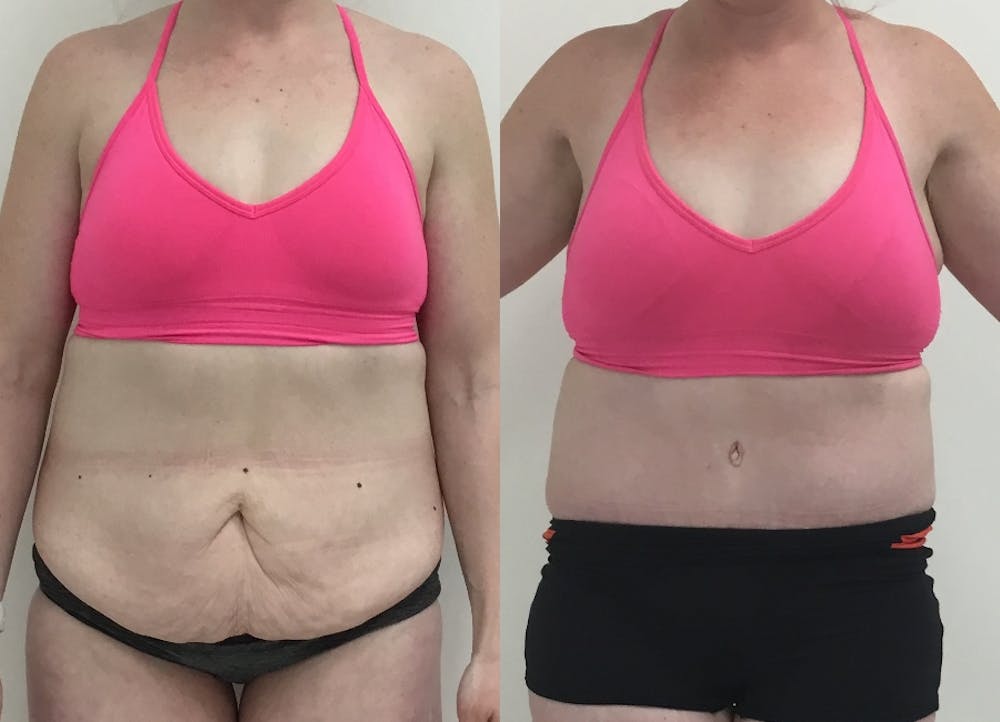 This is one of our beautiful post-bariatric body contouring patient #35