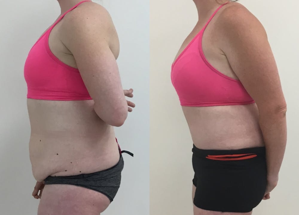 This is one of our beautiful post-bariatric body contouring patient #35
