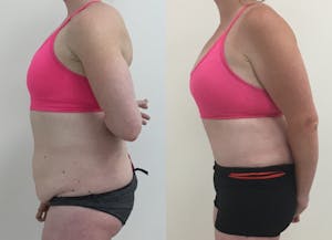 This is one of our beautiful tummy tuck patient 59