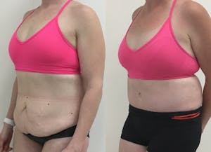 This is one of our beautiful post-bariatric body contouring patient 35