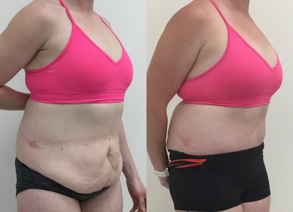 This is one of our beautiful tummy tuck patient #59