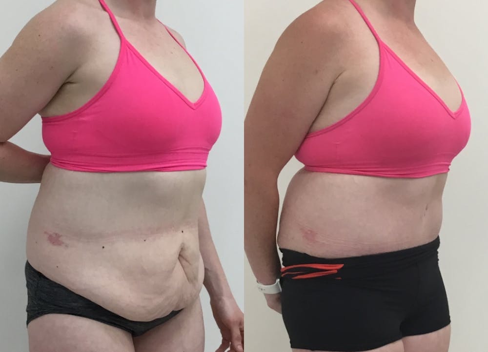 This is one of our beautiful post-bariatric body contouring patient #35