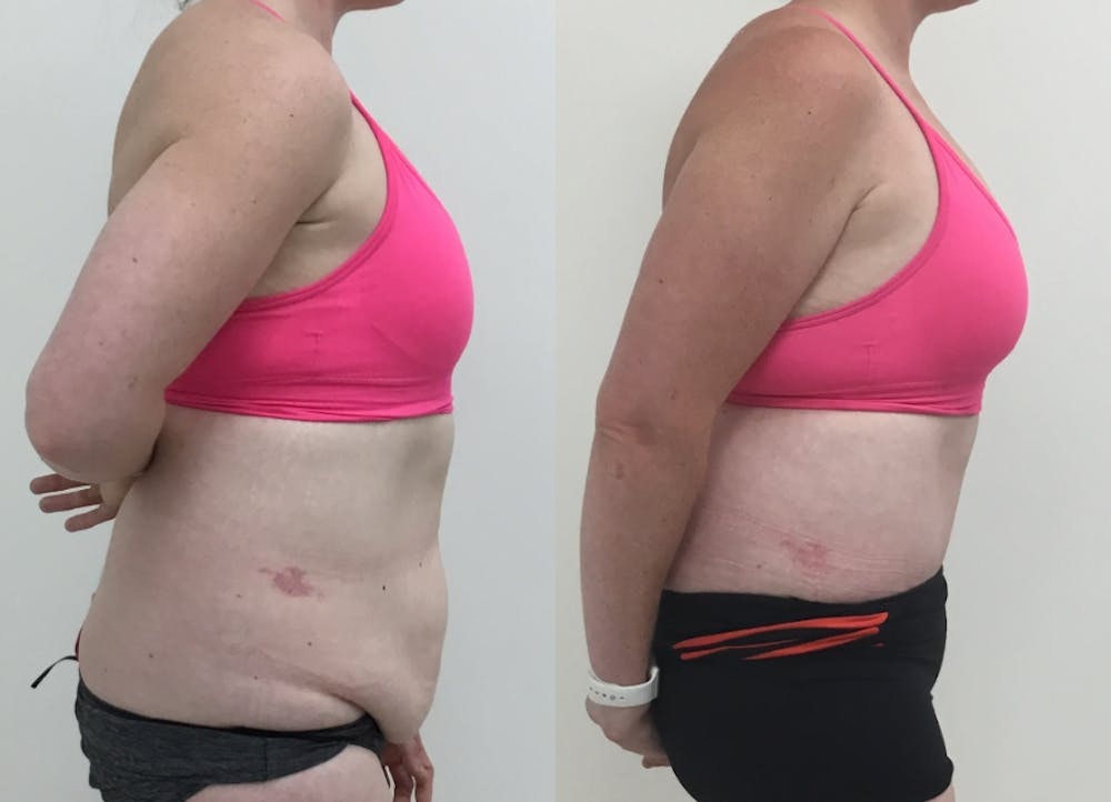 This is one of our beautiful tummy tuck patient #59