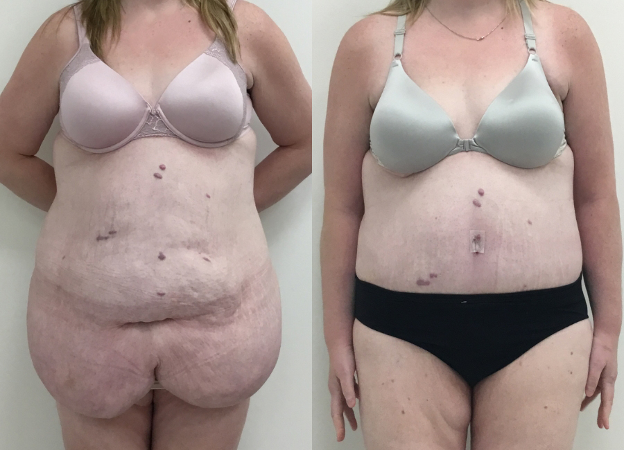 This is one of our beautiful tummy tuck patient 64