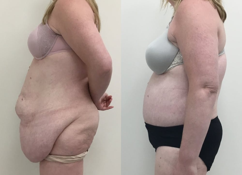 This is one of our beautiful post-bariatric body contouring patient #36