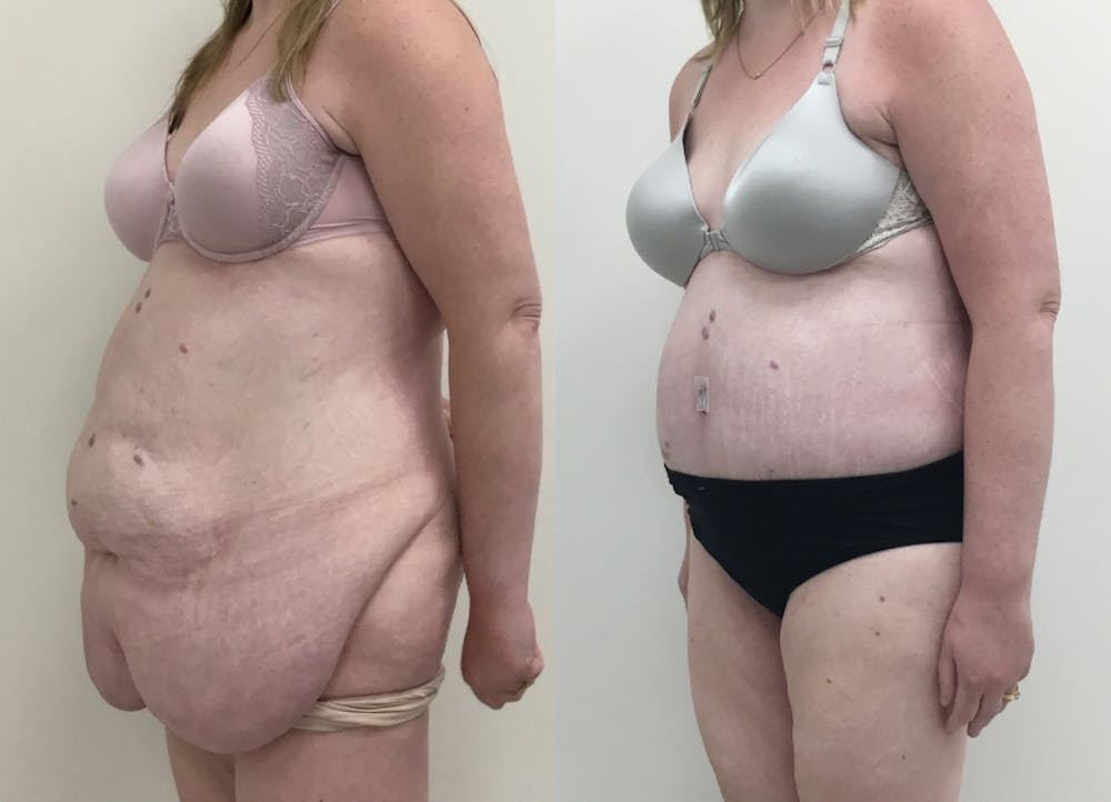 This is one of our beautiful post-bariatric body contouring patient #36