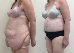 This is one of our beautiful post-bariatric body contouring patient 36