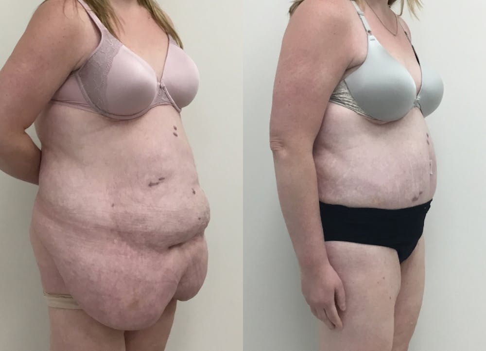 This is one of our beautiful post-bariatric body contouring patient #36