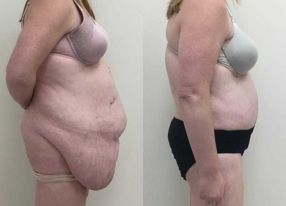 This is one of our beautiful post-bariatric body contouring patient #36