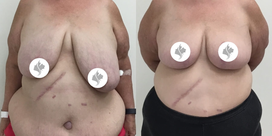This is one of our beautiful breast reduction patient 73