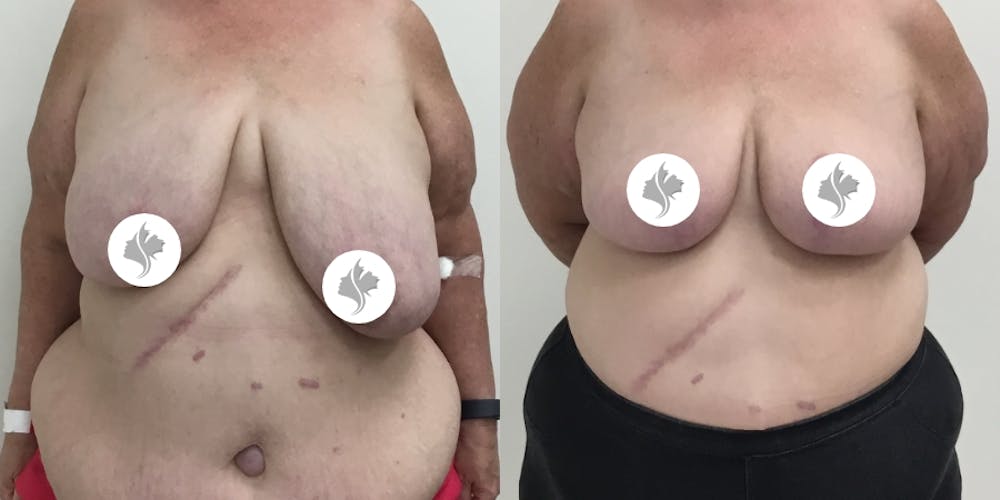 This is one of our beautiful breast reduction patient #73