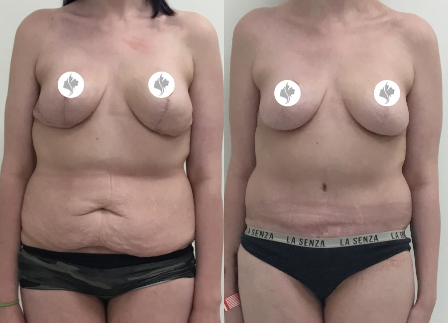This is one of our beautiful tummy tuck patient 61