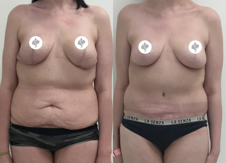 This is one of our beautiful tummy tuck patient 65