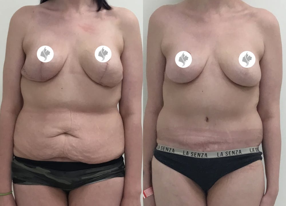 This is one of our beautiful tummy tuck patient #61