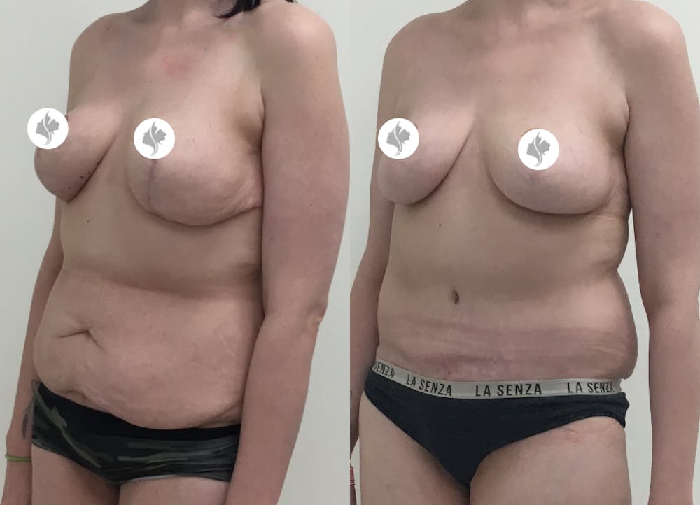 This is one of our beautiful tummy tuck patient #61