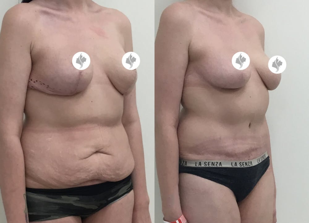 This is one of our beautiful tummy tuck patient #65