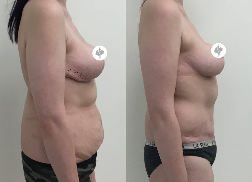 This is one of our beautiful tummy tuck patient #65