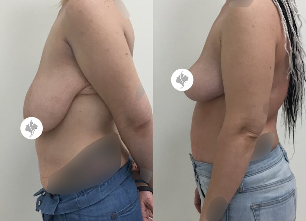 This is one of our beautiful tummy tuck patient #66