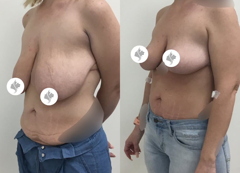 This is one of our beautiful tummy tuck patient #66