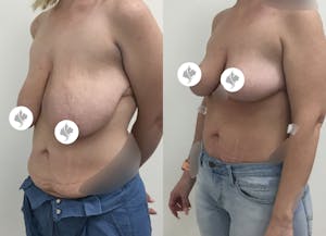 This is one of our beautiful tummy tuck patient 62