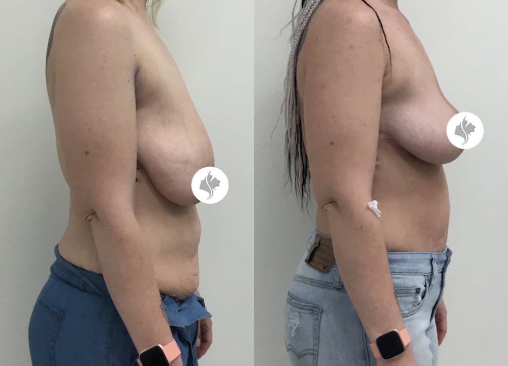 This is one of our beautiful tummy tuck patient #66