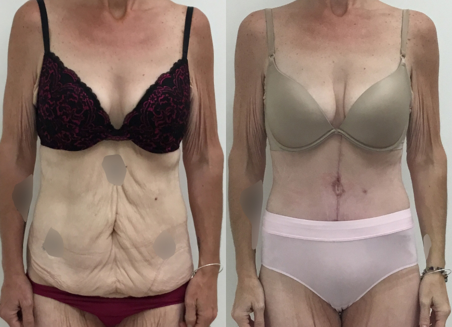 This is one of our beautiful tummy tuck patient 68