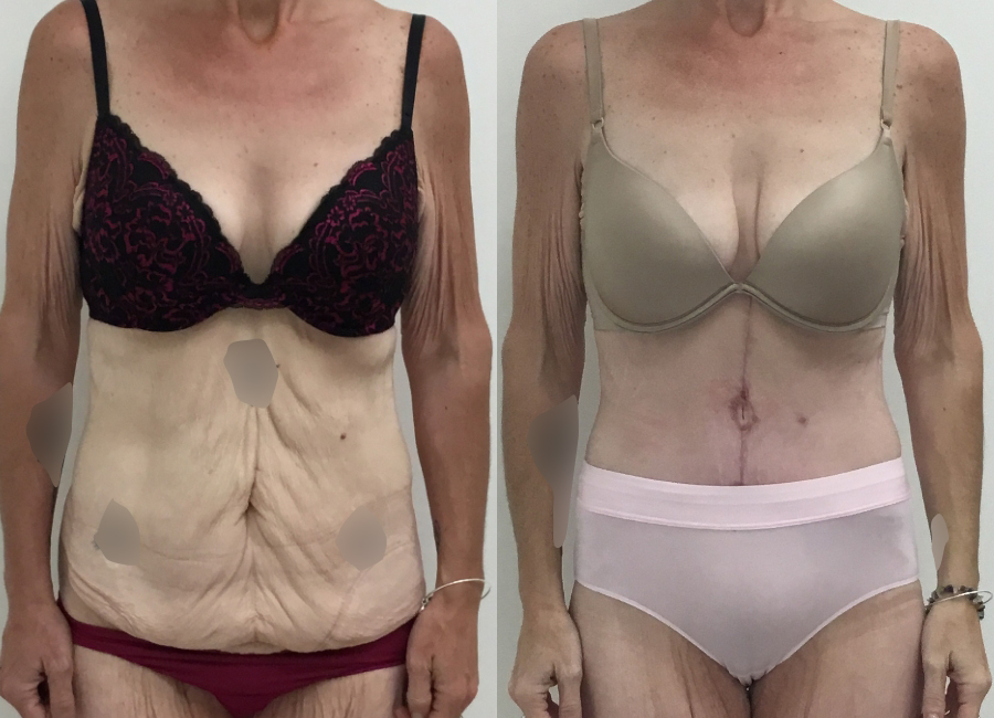 This is one of our beautiful post-bariatric body contouring patient 20