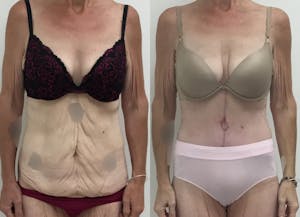 This is one of our beautiful tummy tuck patient 64