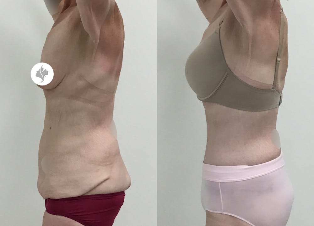 This is one of our beautiful post-bariatric body contouring patient #20