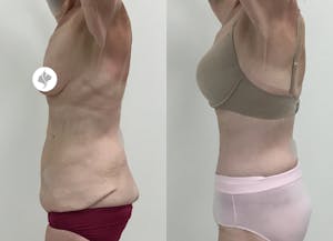 This is one of our beautiful post-bariatric body contouring patient 20