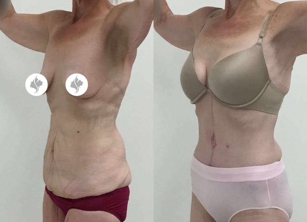 This is one of our beautiful post-bariatric body contouring patient #20