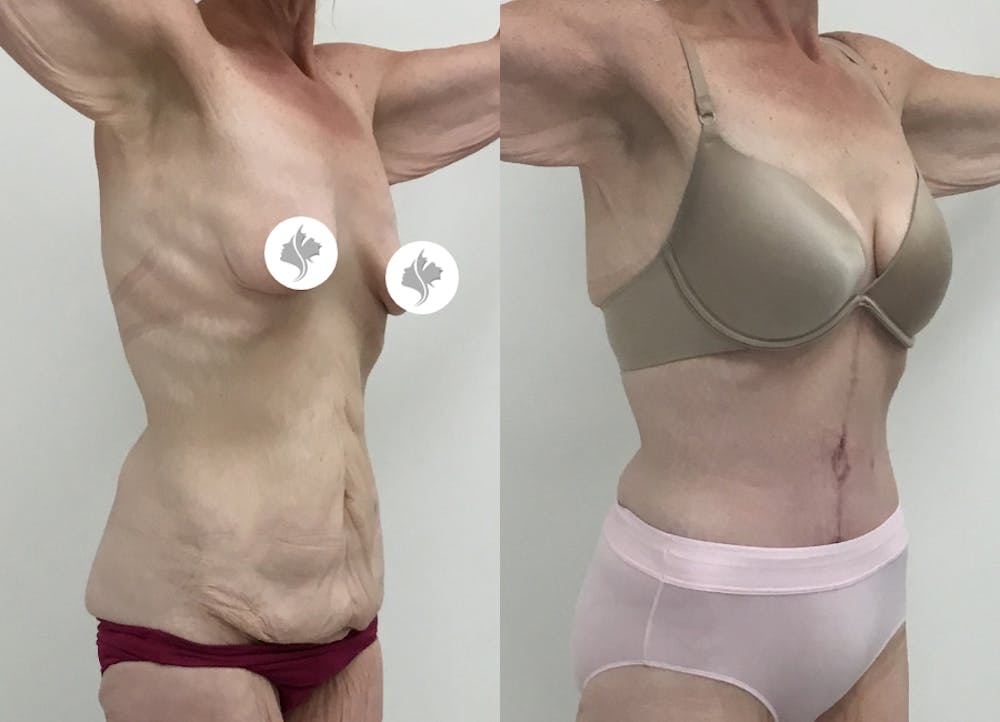 This is one of our beautiful post-bariatric body contouring patient #20