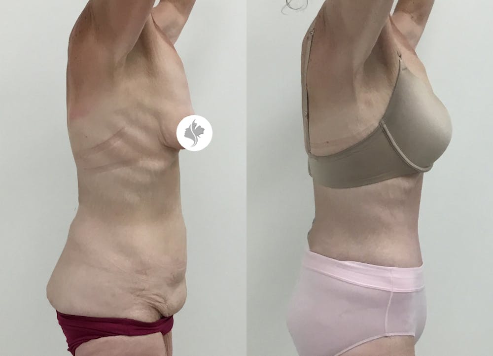 This is one of our beautiful tummy tuck patient #64