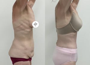 This is one of our beautiful post-bariatric body contouring patient 20