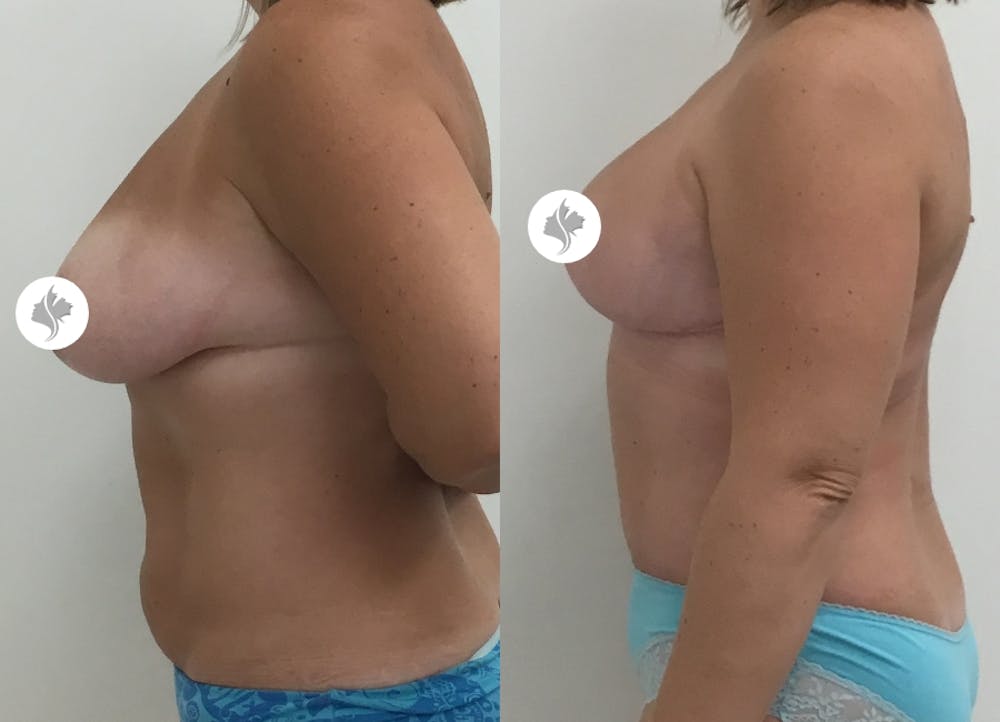 This is one of our beautiful tummy tuck patient #65