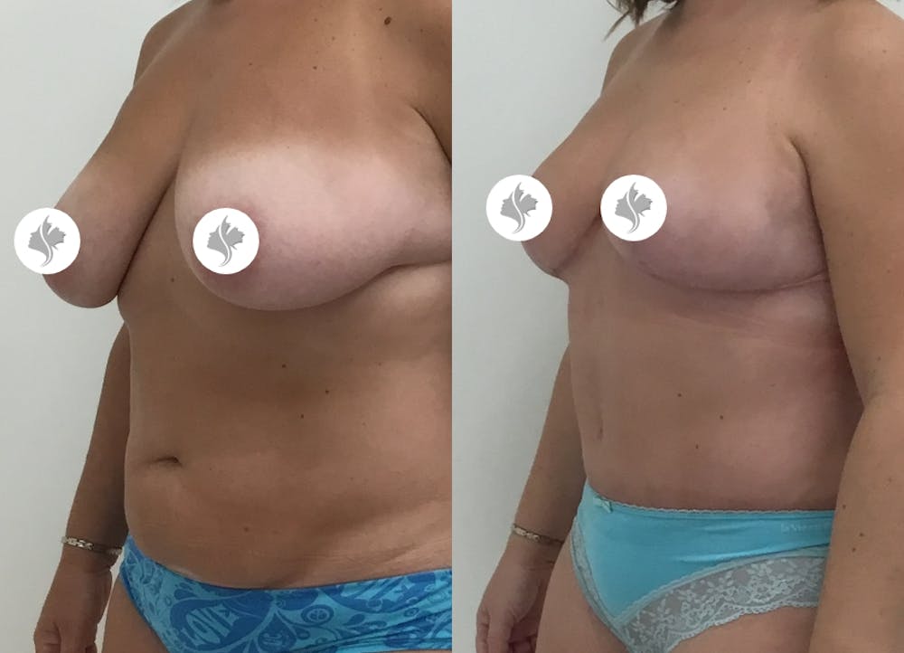 This is one of our beautiful tummy tuck patient #69