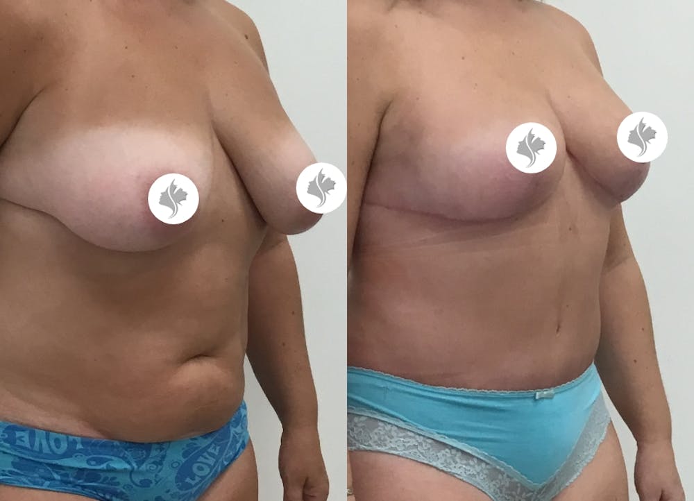 This is one of our beautiful mommy makeover patient #12