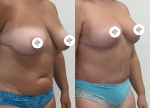 This is one of our beautiful tummy tuck patient 65