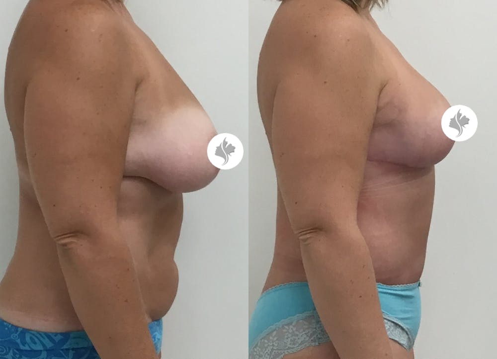 This is one of our beautiful tummy tuck patient #69