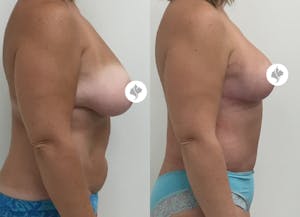 This is one of our beautiful tummy tuck patient 65
