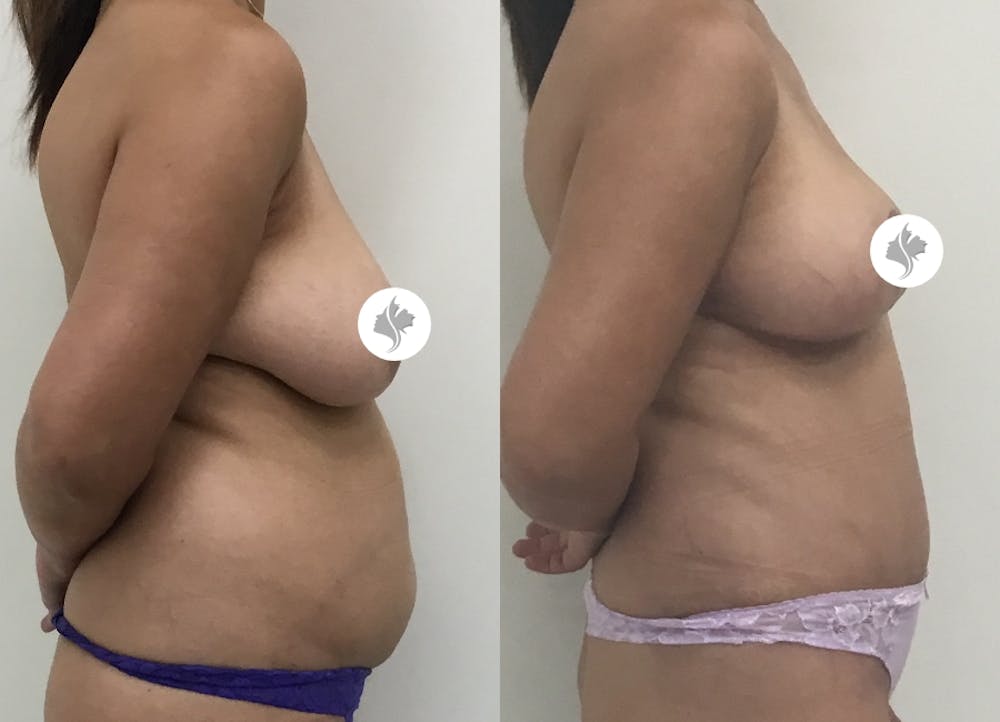 This is one of our beautiful tummy tuck patient #70