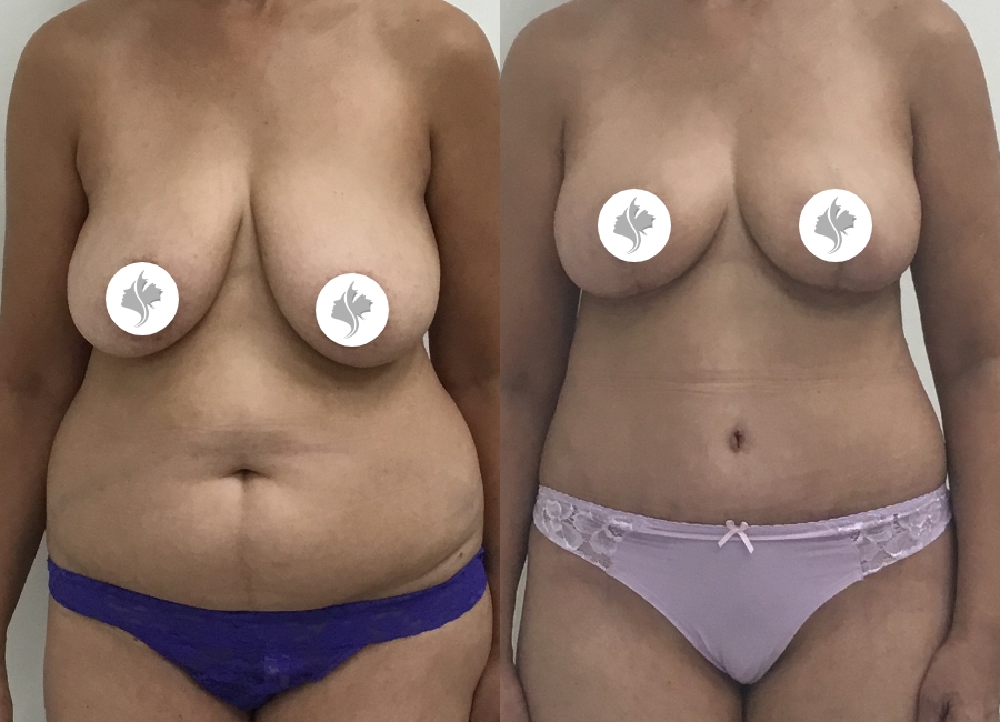 This is one of our beautiful tummy tuck patient 66