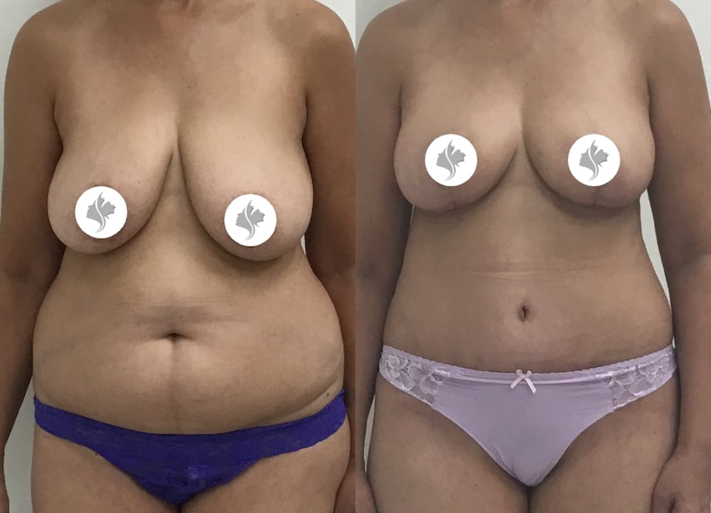 This is one of our beautiful tummy tuck patient #70