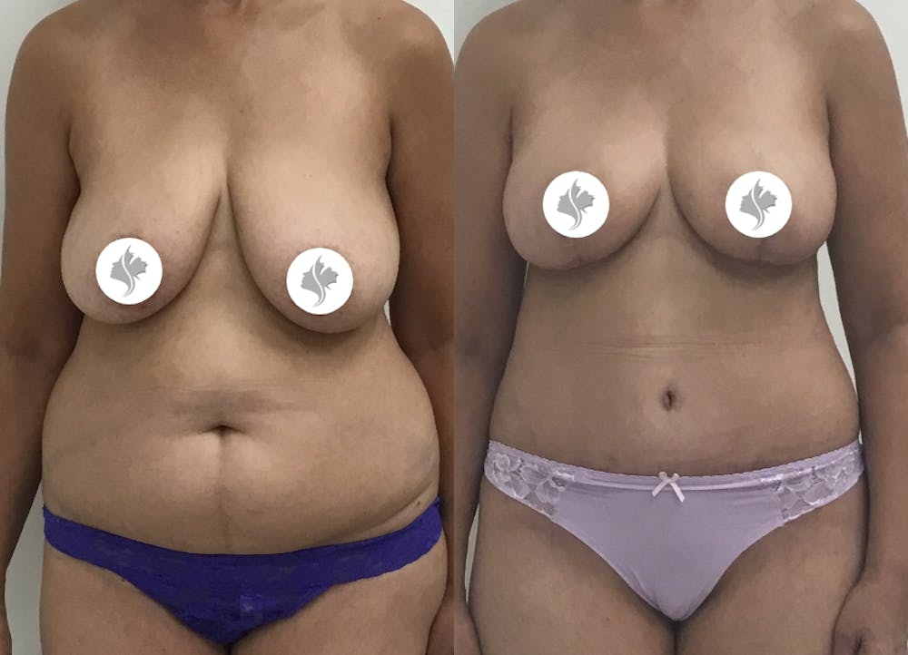 This is one of our beautiful tummy tuck patient #66