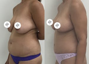 This is one of our beautiful tummy tuck patient 66
