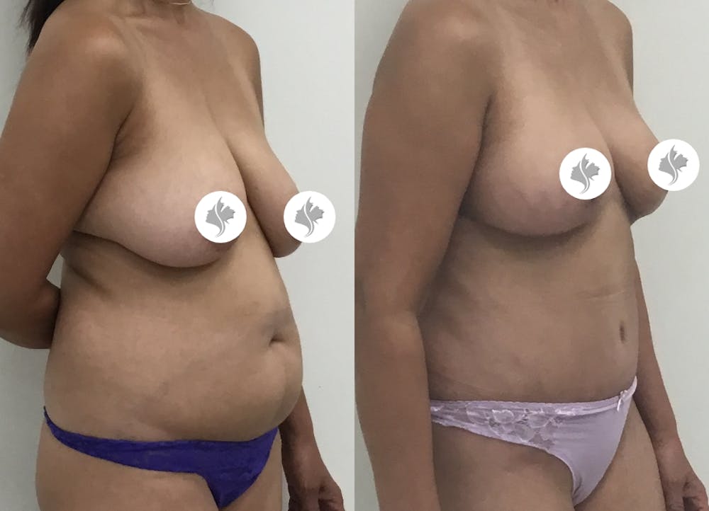 This is one of our beautiful tummy tuck patient #70